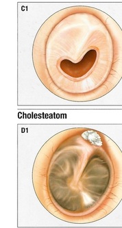 Trommelfellbefund Cholesteatom